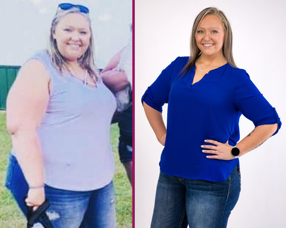 Mackenzie's Before and After Gastric Sleeve Photos